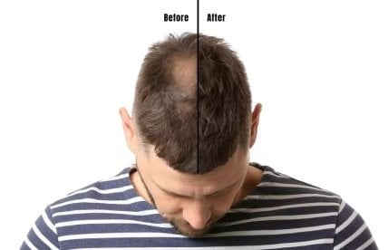 Saç Dökülmesinde Erken Müdahale Önemli midir?