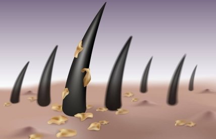 Saç Derisi Hastalıkları Saçı Döker mi?