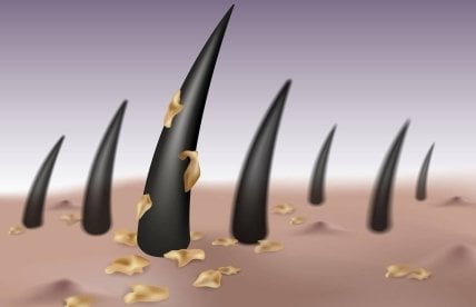 Saç Derisi Hastalıkları Saçı Döker mi?