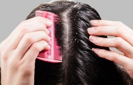 Schäden durch Schuppen für die Kopfhaut?
